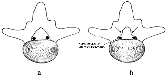 Horizontalschnitt durch die Lendenwirbelsäule in einem normalen und einem stenotischen Segment